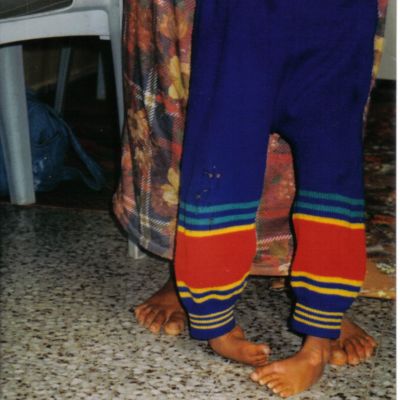 Το διαρκές κάθισμα στο έδαφος πιθανά να δημιουργήσει παραμορφώσεις στον άκρα πόδα